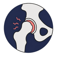 Arthritis
